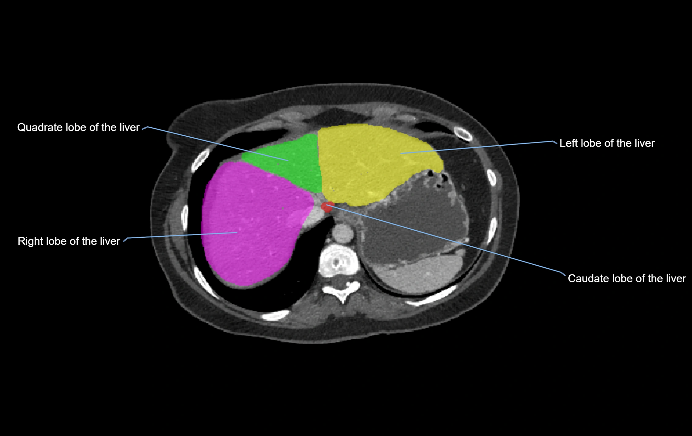 CT lliver lobes axial cross sectional anatomy labelled image -00065.webp